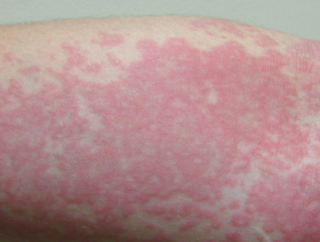 Symptoms of Covid : Coronavirus: Skin rash can be just COVID-19 manifestation and ought to be fourth key sign, study finds